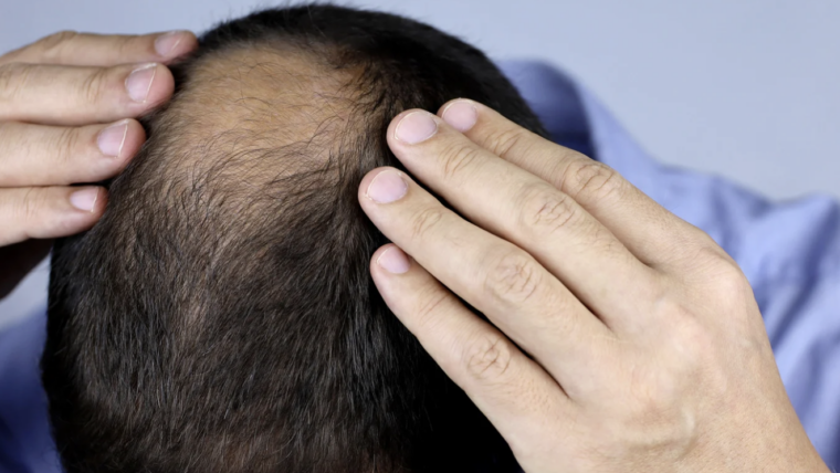 Where to Book a Hair Graft Transplant Appointment Near Bethesda, MD
